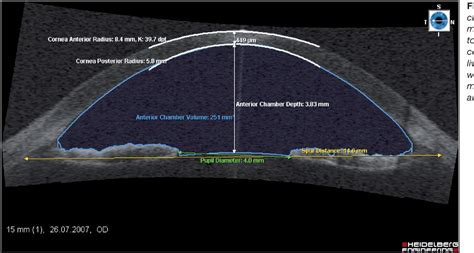 ultrasound for corneal thickness